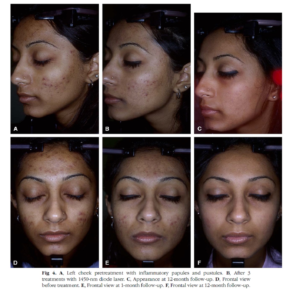 T R A Y C E | World’s leading technologies for treatment of acne and ...